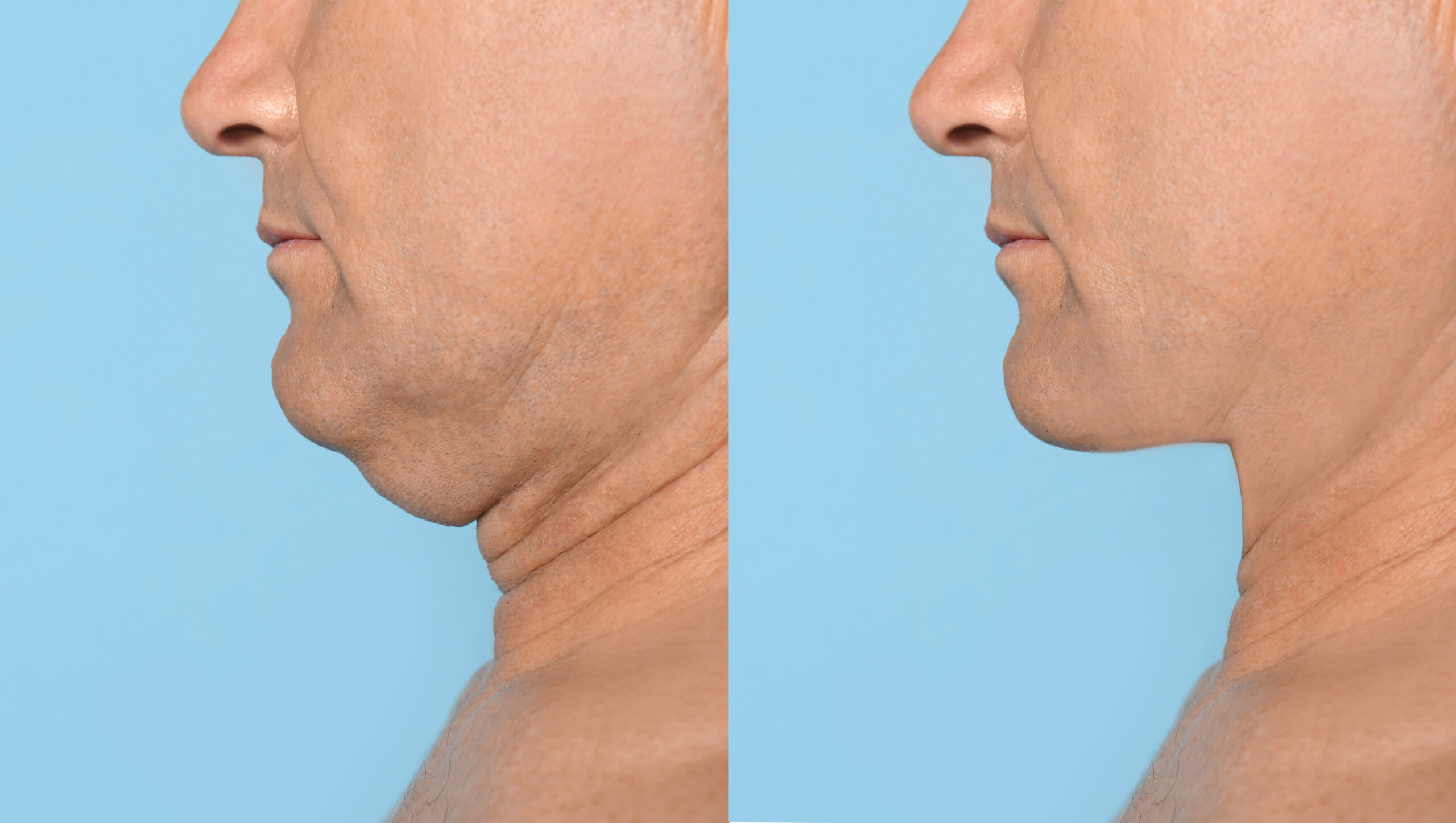 The before and after pictures of a man that received Kybella treatment for his double chin.