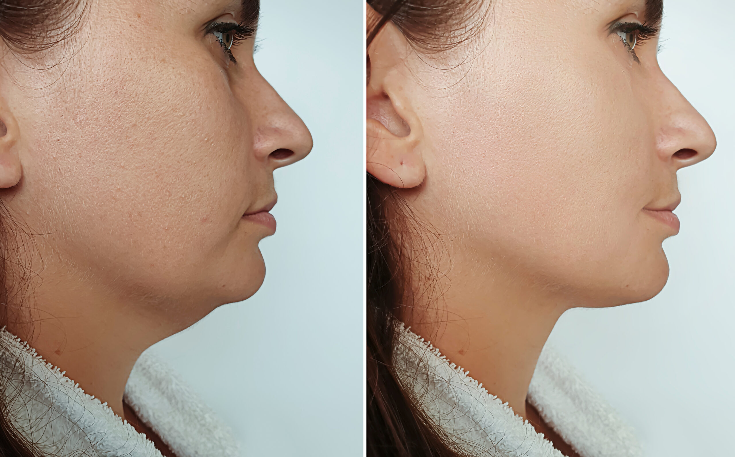Before and after pictures of a woman who received the Kybella treatment for her double chin.