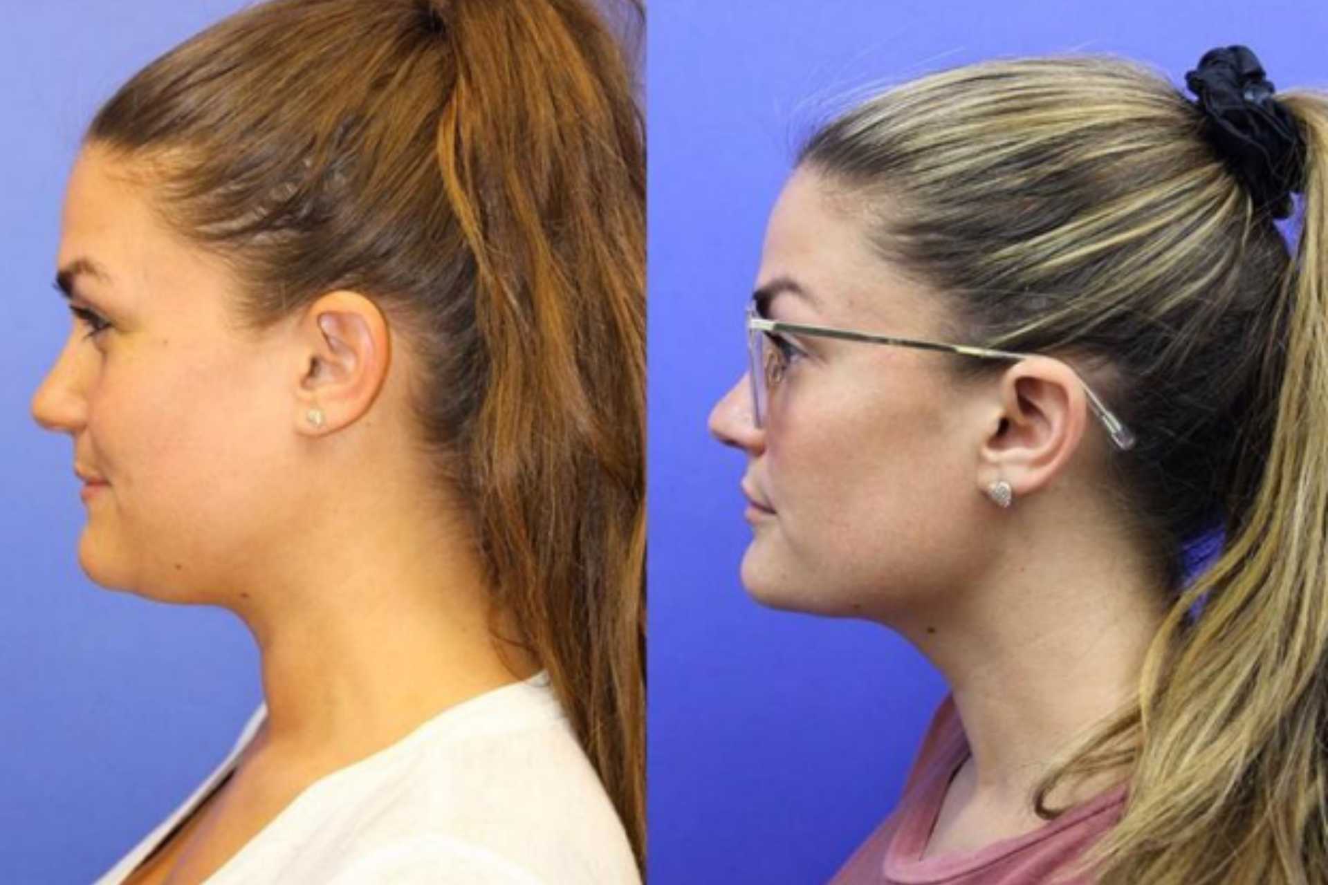 How Long Does Kybella Last