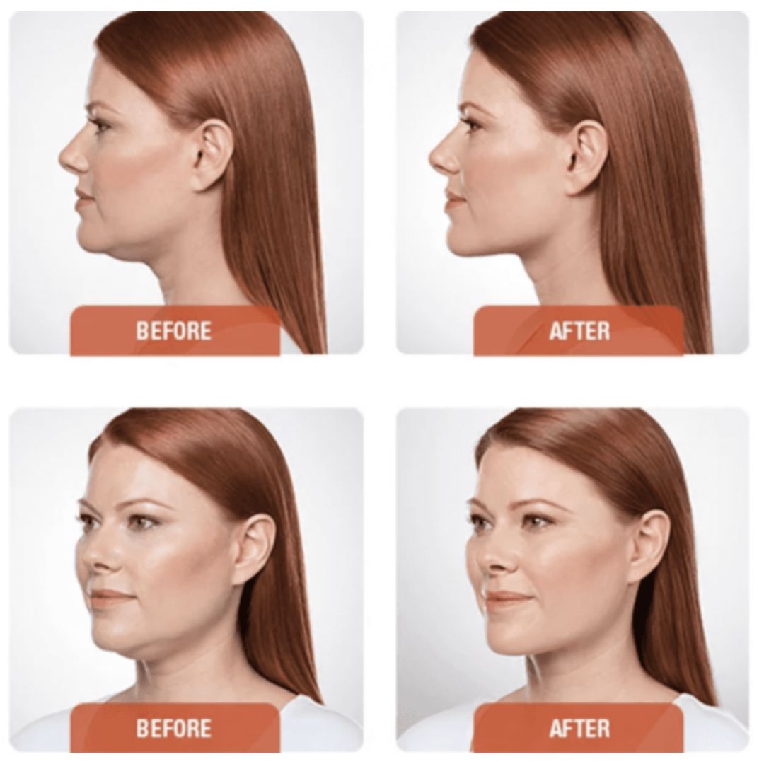 Results of Kybella